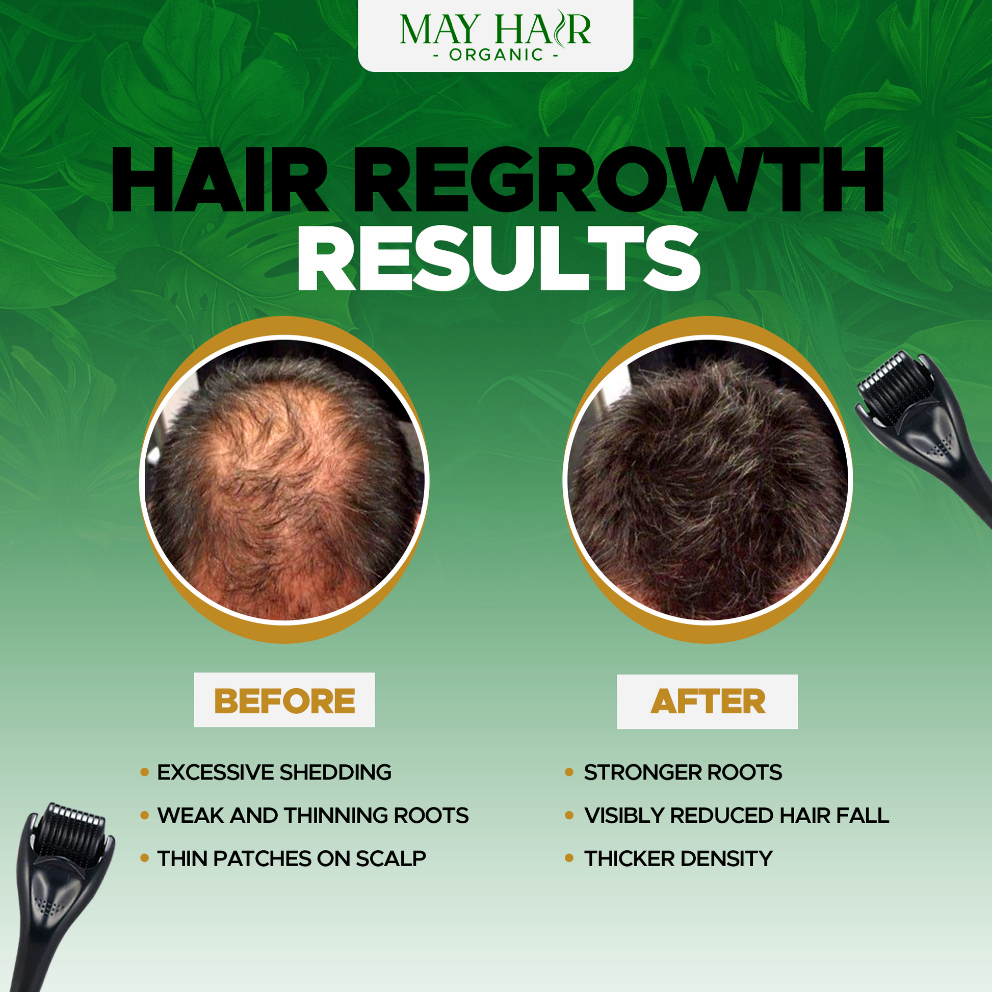 Derma Roller 0.25mm – Microneedles for Hair Growth, Beard Growth & Skin Rejuvenation